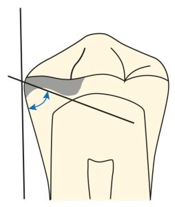 Şekil 10-33. Tırnak yuvasının tabanı ve dişin proksimal yü­zeyinden dişin uzun aksına paralel olarak çizilen doğru arasın­daki açı 90°’den az olmalıdır.