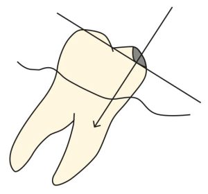 Şekil 10-34. Meziale eğimli mandibular molar dişte hazır­lanacak olan tırnak yuvasının tabanı dişin uzun aksına dik ol­duğunda, dişin daha fazla meziale devril­mesi önlenebilir.