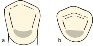 Şekil 10-47. “U” veya “C” singulum tırnak yuvasının a)lingual, b) insizal yüzeyden görünümü.