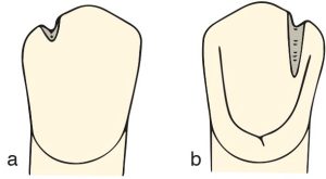 Şekil 10-48.İnsizal tırnak yuva­sının a) vestibül, b) lingual yüzeyden görünümü.