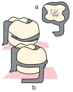 Şekil 3-15.a) Halka kroşe başlangıç noktasından itibaren, neredeyse tüm diş yüzeyini kaplar. b) Kroşe meziolingual yüzeyden başlar ve meziobukkal andırkatta sonlanır ve kroşeyi destekleyen ilave bir minör bağlayıcı kullanılır.