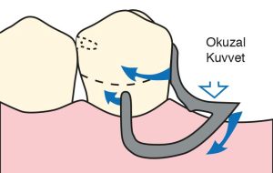 Şekil 3-24. Uygun doku rölyefi ile yapılan ve proksimal yüzün orta ve gingival 1/3’üne kadar uzanan proksimal plağa sahip bir I bar kroşe tasarımı, fonksiyonel kuvvetleri daha eşit şekilde dağıtır.