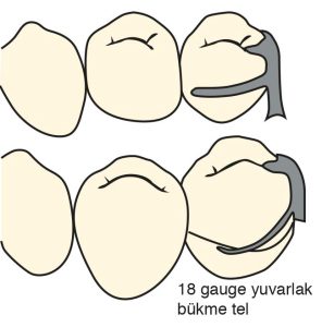 Şekil 3-27.a) Kombine kroşe, döküm stabilizasyon kolu ile uca doğru inceltilmiş, yuvarlak bükme telden yapılan tutucu koldan oluşur.