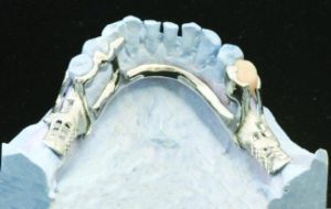 Şekil 5-12. Lingual barın üst kenarı alt ön dişlerin gingival marjinlerinden 2-3 mm uzakta seyreder. Alt kenarı ise lingual sulkusun 1 mm üstünde konumlanır.