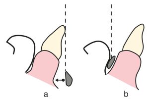 Şekil 5-20. Linguale eğimli alt ön dişlerin varlığında;a) Lingual barın mukoza ile mesafesinin arttırılması gerekir.  b) Labial barın kullanımı daha doğru olur.