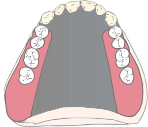 Şekil 5-9. Arka hududu yumuşak ve sert damağın birleşim bölgesinde yer alan tam palatal plağın ön bölgesi, singulum tırnakları ile desteklenmiştir.