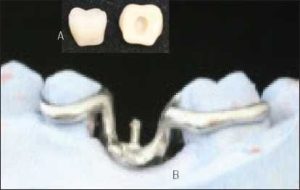 Şekil 6-10. Posterior tek diş eksikliğinde tüp diş (A) ve metal alt yapıda oluşturulan pin tutucu (B)