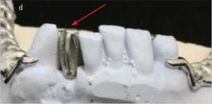 Şekil 6-5d. Faset diş: Metal alt yapıda üst santralin palatinal (d) görünümleri.