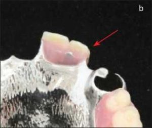 Şekil 6-8b. Santral ve lateral diş için metal alt yapıda oluşturulan güçlendirilmiş gövde bitmiş görüntüsü