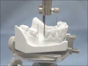 Şekil 7-12. Proksimal diş yüzeylerinin paralelliği, modelin dikey kol ile ilişkili “anteroposterior “ eğimini belirler.