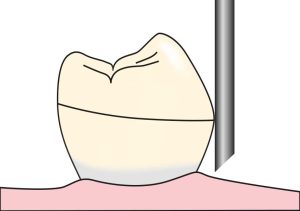 Şekil 7-16. Destek diş üzerindeki ekvator hattı belirlenirken, çizici ucun yan yüzeyi dişin horizontal düzlemdeki en dış bükey yüzeyine temas ettirilir.