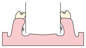 Şekil 7-7. Mandibular dişler linguale doğru aşırı eğimli olduğunda, lingual barın uygun şekilde yerleştirilmesine engel olacağından, model analizinde tespit edilmelidir.