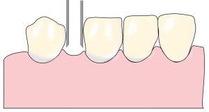 Şekil 7-9. Anterior dişsiz boşlukların estetik açıdan değerlendirilmesi ve problemlerin giderilmesinde model analizi kullanılabilir.