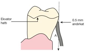 Şekil 8-18. Diş yüzeyindeki daha küçük andırkatın kullanımında, diş ve tutucu arasında geniş bir mesafe (A) kalır.