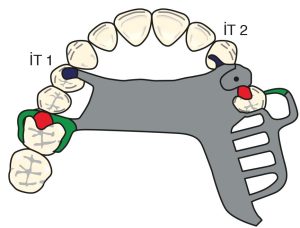 Şekil 8-35. Fulkrum ekseninin karşıt arkı kestiği birinci premolarda kullanılan yardımcı okluzal tırnak (İT 1) indirekt tutucudur. Dişsiz bölge tarafındaki kanin uzantısı (İT 2), karşıt arktaki kadar etkili olmasa da yine indirekt tutuculuk yapar.
