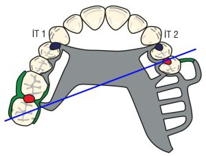 Şekil 8-36. Serbest sonlu bölgenin karşıt tarafındaki premolar üzerindeki yardımcı okluzal tırnak (İT 1), fulkrum eksenine daha uzak olduğundan, serbest sonlu tarafta yerleştirilen tırnaktan (İT 2) daha etkili bir indirekt tutuculuk sağlar.