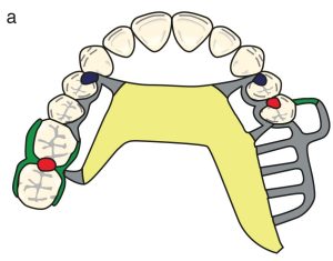 Şekil 8-40a. Doku desteği gerekli olmadığında ana bağlayıcı tercihleri. a) Palatal bant