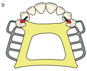 Şekil 8-40b. Doku desteği gerekli olmadığında ana bağlayıcı tercihleri. b) Anteroposterior bar