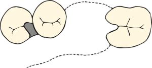 Şekil 8-5. İkinci premolar diş, periodontal açıdan zayıf desteğe sahip olduğunda, okluzal tırnak birinci premolar dişe yerleştirilir.