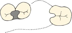 Şekil 8-6. Birinci ve ikinci premolar dişler periodontal açıdan zayıf olduğundan, okluzal tırnak her iki destek dişe birlikte yerleştirilerek, yük dağılımı sağlanır.