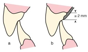 Şekil 8-7. a) Alt ve üst kanin dişleri arasında temas olduğunda b) Singulum tırnağı, bu temas noktası ile gingival marjinin 2 mm yukarısı arasındaki herhangi bir bölgeye yerleştirilir.