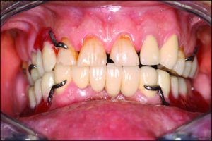 Şekil 9-9. Mandibular bilateral serbest sonlu protezlerde tek taraflı balanslı okluzyon yeterlidir. Çalışmayan tarafta temas yoktur.