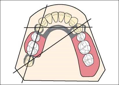 Balancing the stress transmitted to teeth and edentulous areas – A ...