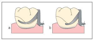 Figure 1-29. The retentive arm of the Akers clasp in form (a) has a greater curvature and is therefore longer, which makes it more flexible compared to the one in form (b).