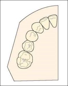 Figure 1-31. The splint must extend along the arch's curvature and incorporate the canine tooth in order to stabilize the teeth in the buccolingual direction.