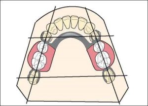 Figure 1-37. In the quadrilateral clasp design, a clasp is placed at both ends of the edentulous space. This arrangement provides maximum retention and stability.