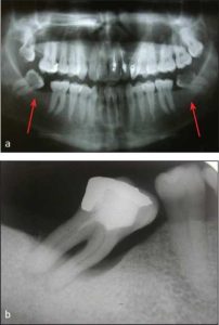Figure 10-1. Radiographic views of molar teeth that are mesially tipped, have a questionable prognosis, and are likely to complicate prosthetic planning: a) panoramic view, b) periapical view.