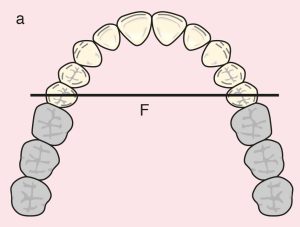 Şekil 11.1. Vaka 1: a) Cl I: 15 ve 25 no’lu terminal desteklerden geçen diametrik fulkrum ekseni . b) Metal alt yapı planı