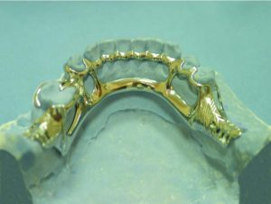 Figure 4-6. Cingulum bar used as an indirect retainer, supported by auxiliary occlusal rests placed in the mesial fossae of the first premolars.