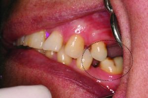 Figure 10-17. Loss of teeth in the posterior region may cause the lower molar to drift mesially and the upper premolars to drift distally.
