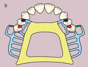 b) Metal framework design.