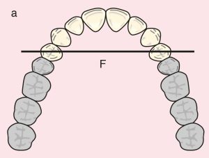 Figure 11.2. a) Cl I: The diametric fulcrum axis passing through the terminal abutments 14 and 24.