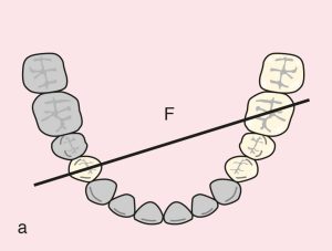 Figure 11.48. a) Cl II Mod 1: Diagonal fulcrum line passing through the terminal abutments of teeth 44 and 36.