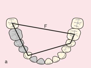 Figure 11.51. a) Cl III Mod 1: Quadrangular support plane between terminal abutments numbered 43, 47, 35, and 36.