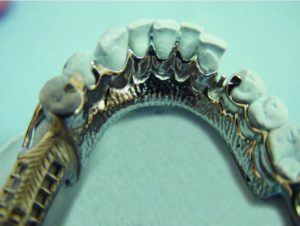 Figure 4-7. The lingual plate, used in conjunction with auxiliary occlusal rests placed in the mesial fossae of the first premolars, serves as an effective indirect retainer.