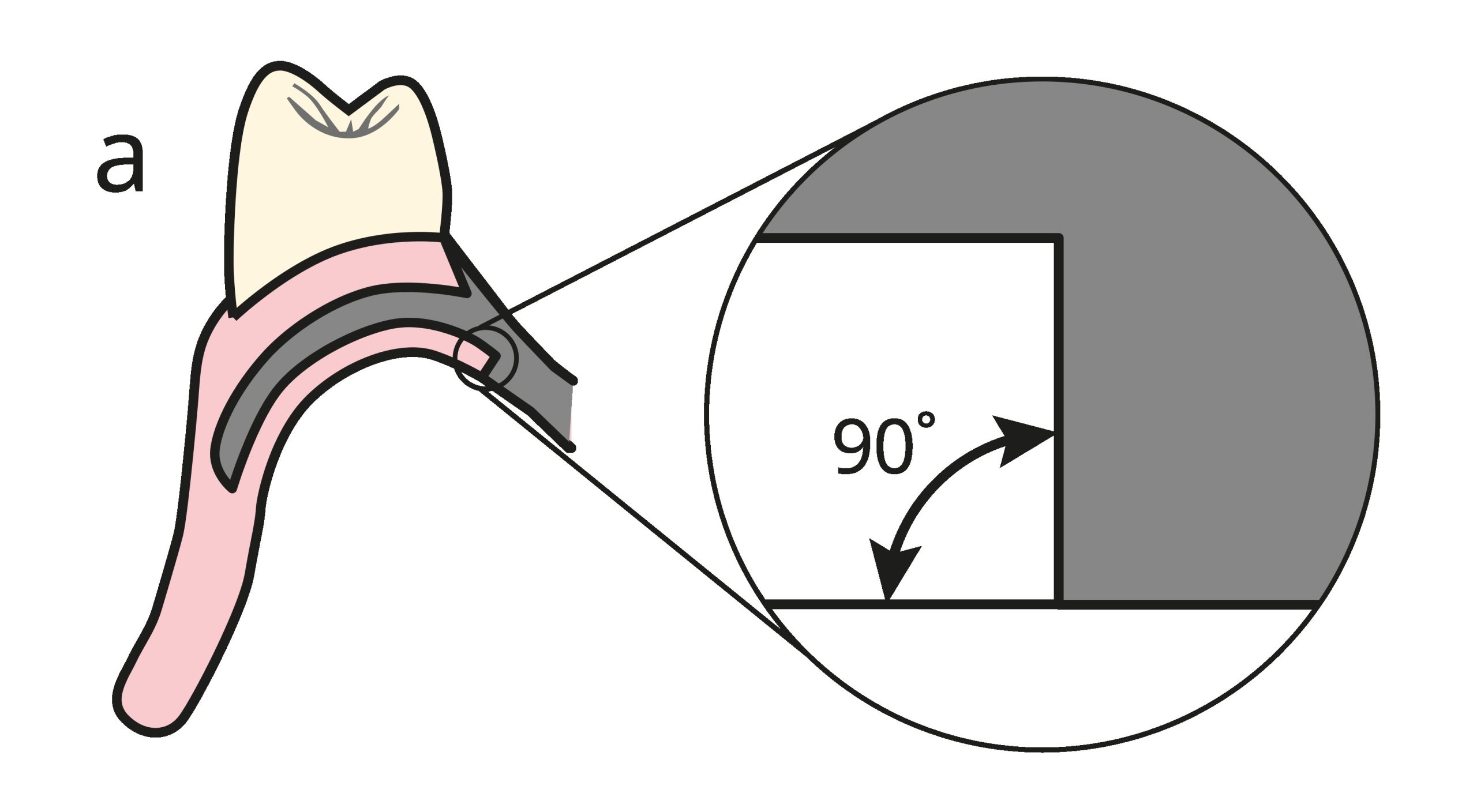 Figure 5-24a. Junction angles between the major connector and the acrylic resin. A 90° angle is formed on the tissue surface.