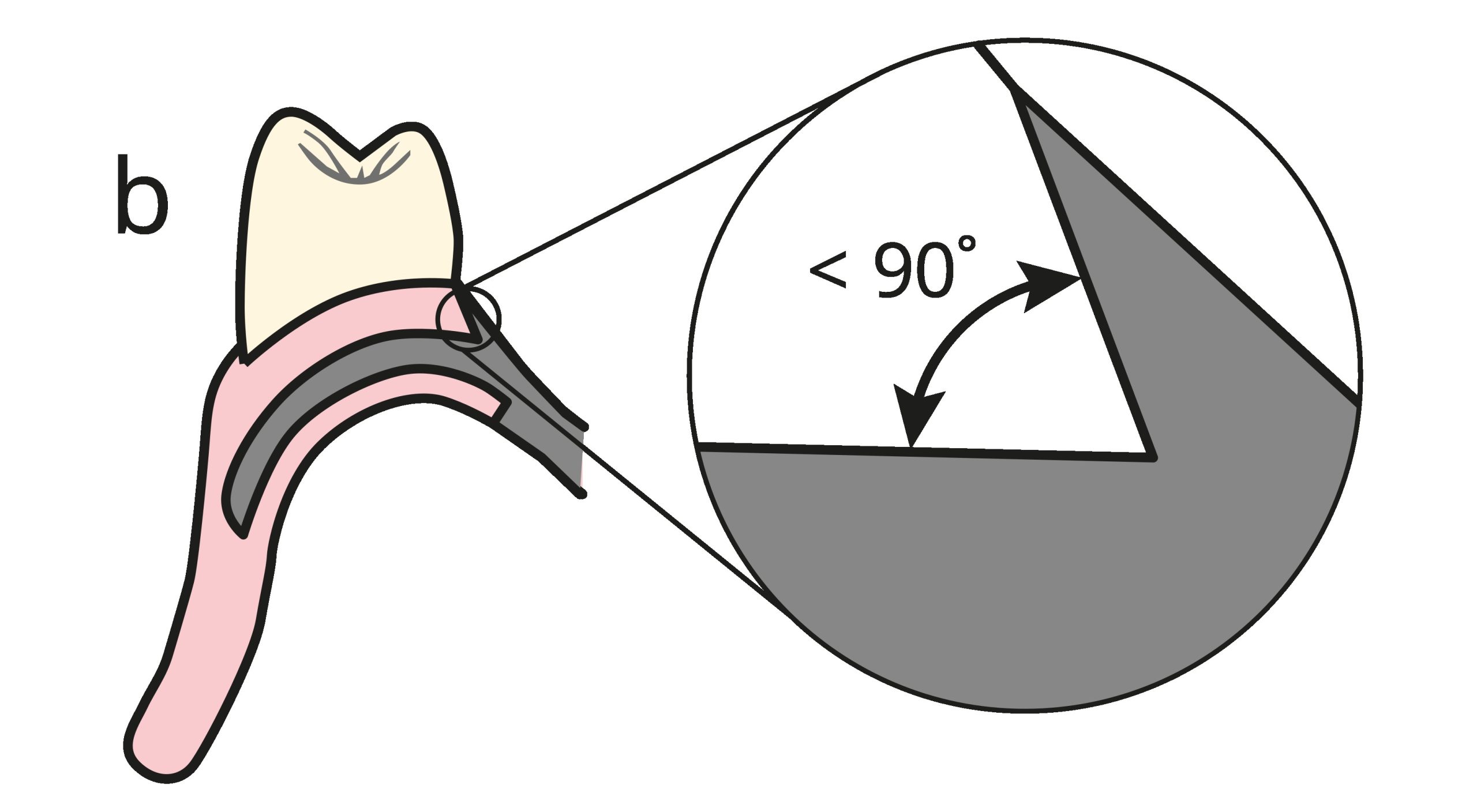 Figure 5-24b. On the polished surface of the prosthesis, the junction angle is made less than 90° to enhance mechanical retention.