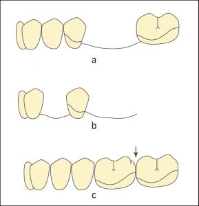 Figure 8-11. Examples of Class I survey lines according to the positions of the abutment teeth in the arch and the types of edentulous spaces; a) abutment adjacent to the edentulous space, b) single or distal extension abutment, c) opposing arch abutments.