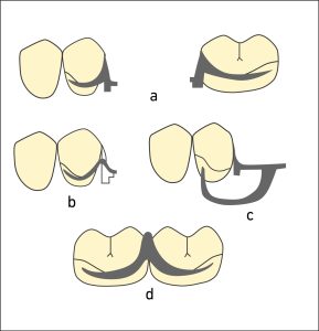 Figure 8-12. Clasp options for Class I survey line: For tooth-supported edentulous spaces, a) circumferential Akers clasp. For distal extension edentulous spaces or single abutments, b) wrought wire clasp or c) I-bar clasp. For abutments in the opposing arch, d) double Akers clasp.