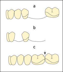 Figure 8-13. Examples of Class II survey lines according to the positions of the abutment teeth in the arch and the types of edentulous spaces; a) abutment adjacent to the edentulous space, b) single or distal extension abutment, c) opposing arch abutments.