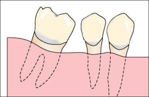 Figure 1-28. Tooth migrations causing changes in occlusion.