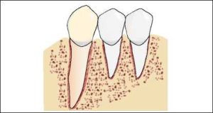 Figure 1-32. When the roots of an abutment tooth are short or tapered, splinting it with an adjacent tooth creates an effect similar to that of a multi-rooted tooth.