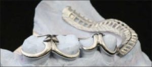 Figure 1-33. Periodontally compromised teeth can be splinted against horizontal forces using multi-arm clasps and rests as part of a removable partial denture.