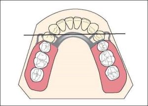 Figure 1-39. The bilateral clasp design is used in Class I cases.